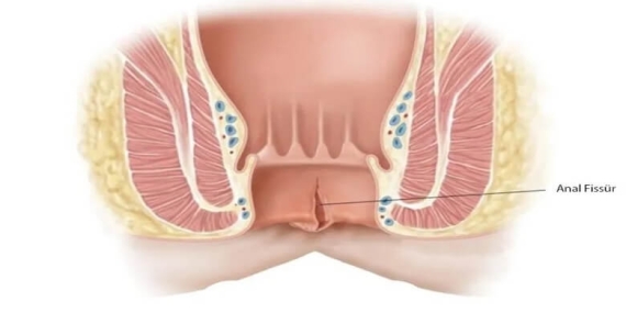 Anal Fissür